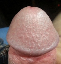 Foto do pene do glande agrandado