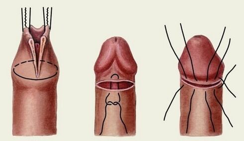 a esencia da cirurxía de ampliación do pene