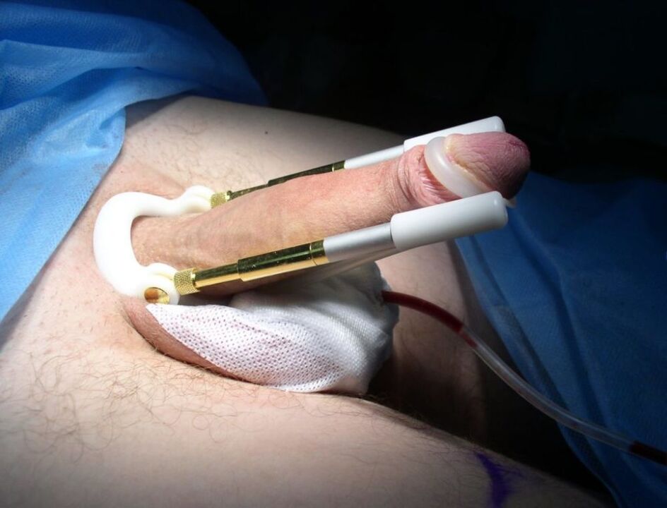 Extensor despois da cirurxía de ampliación do pene