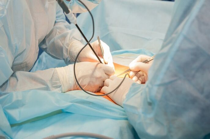 Cirurxía de ampliación do pene
