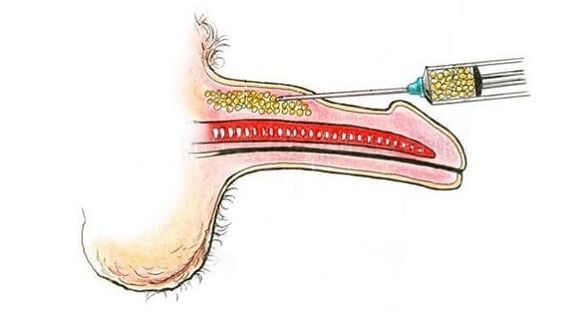 Transplante de tecido muscular para a ampliación do pene