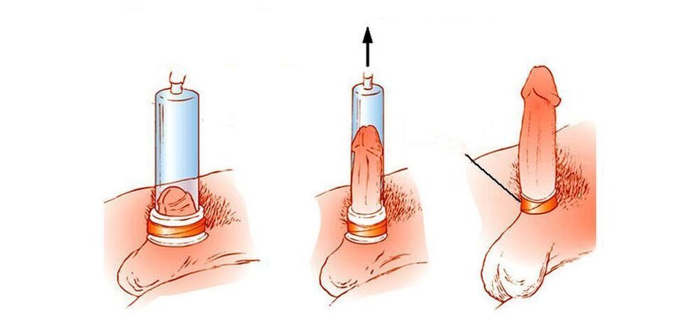 Como funciona unha bomba de baleiro para o pene